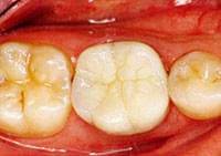 セラミックの被せ物（奥歯）